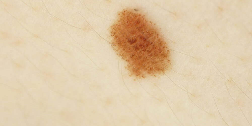 dermatoscopic dermatoscopic