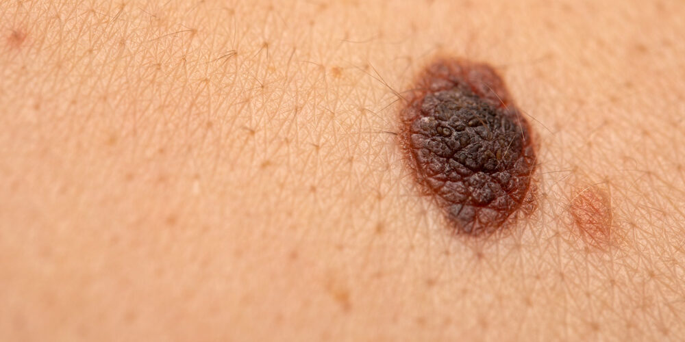 melanoma melanoma