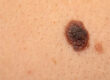 melanoma
