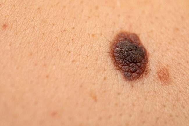melanoma melanoma