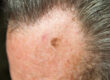 melanoma-in-situ