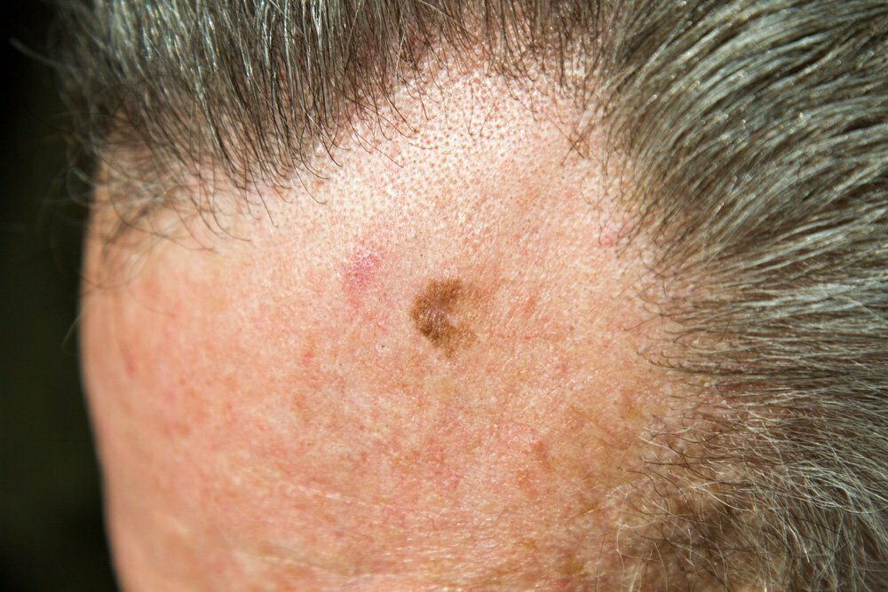 melanoma-in-situ melanoma-in-situ