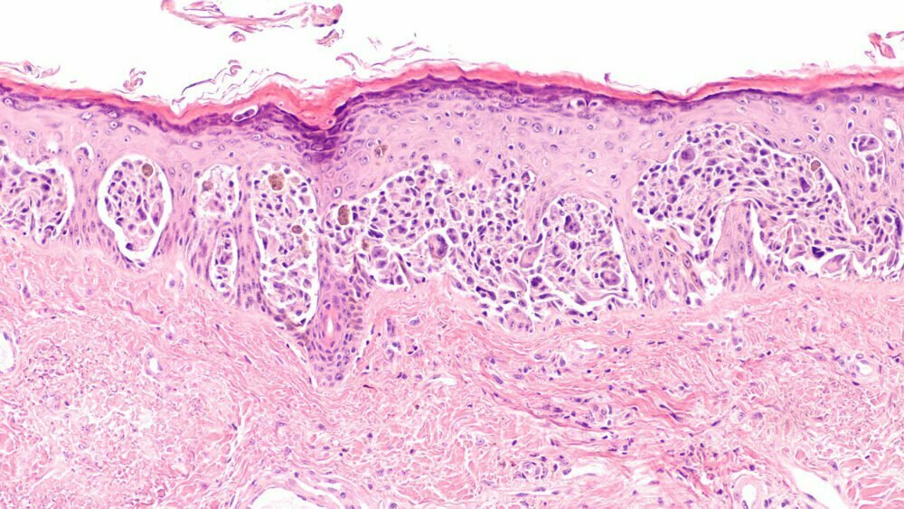 melanoma-insitu