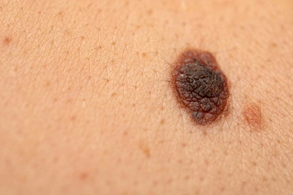 melanoma