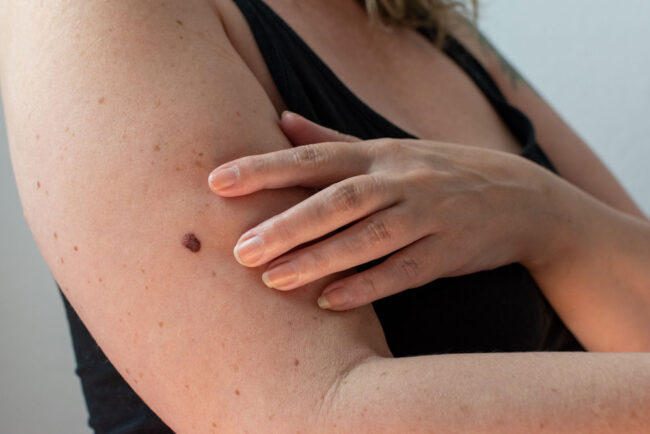 skin-arm skin-arm